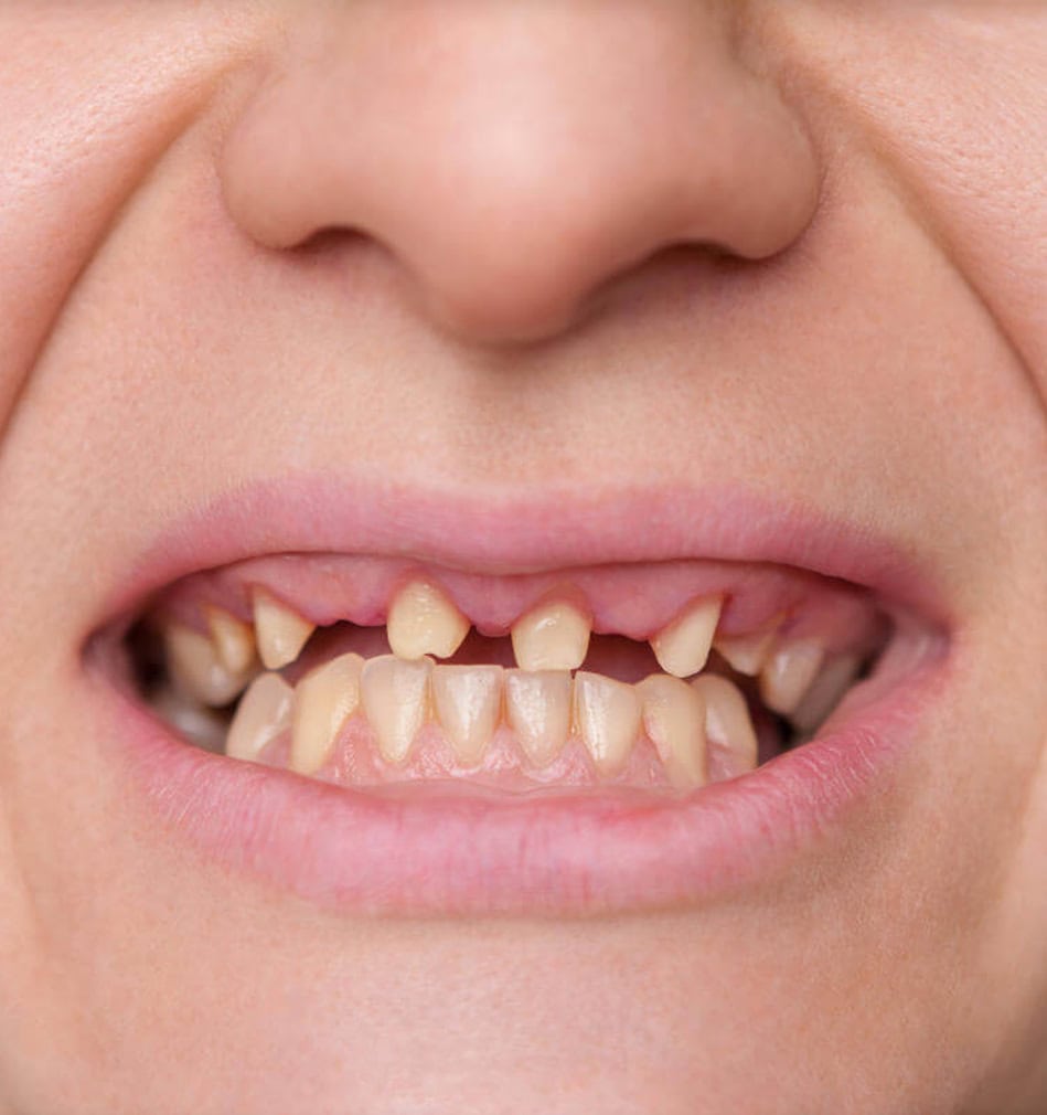 Smile before dental restoration